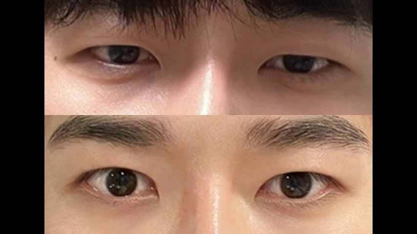Blepharoplasty (눈매교정) 