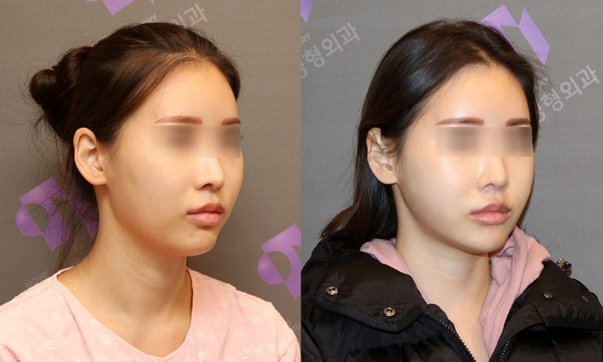 Cheekbone Reduction (광대축소술) 
