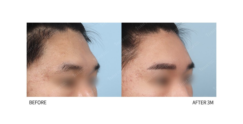 Forehead Augmentation