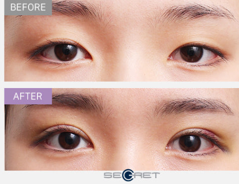 Double Eyelid Surgery (쌍꺼풀 수술)