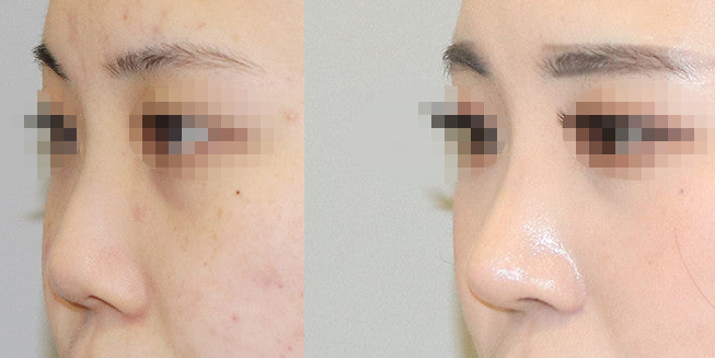 Rhinoplasty (코 성형) 