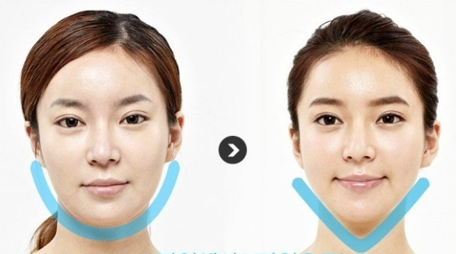 V-Line Surgery (V라인 수술) 